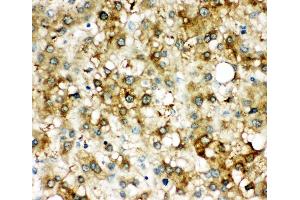Anti-alpha 1 Antichymotrypsin antibody, IHC(P) IHC(P): Human Liver Cancer Tissue (SERPINA3 antibody  (Middle Region))