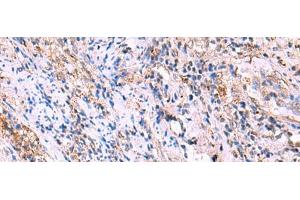 Immunohistochemistry of paraffin-embedded Human cervical cancer tissue using FUCA2 Polyclonal Antibody at dilution of 1:70(x200) (FUCA2 antibody)