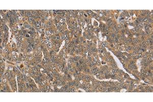 Immunohistochemistry of paraffin-embedded Human cervical cancer using PTPN12 Polyclonal Antibody at dilution of 1:45 (PTPN12 antibody)