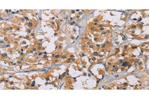 Immunohistochemistry of paraffin-embedded Human thyroid cancer tissue using NME5 Polyclonal Antibody at dilution 1:50 (NME5 antibody)