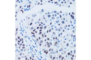 Immunohistochemistry of paraffin-embedded human lung cancer using TP53 antibody (ABIN4905469) at dilution of 1:100 (40x lens). (p53 antibody)
