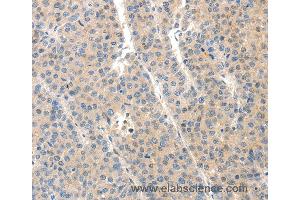 Immunohistochemistry of Human ovarian cancer using SLC20A1 Polyclonal Antibody at dilution of 1:40 (SLC20A1 antibody)