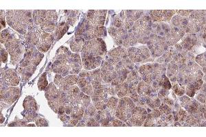ABIN6273279 at 1/100 staining Human pancreas cancer tissue by IHC-P. (OMA1 antibody  (Internal Region))