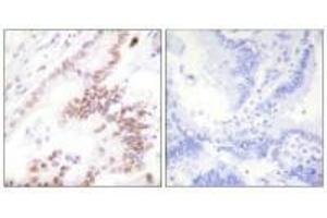 Immunohistochemistry analysis of paraffin-embedded human lung carcinoma tissue using p300 antibody. (PTGER3 antibody  (N-Term))