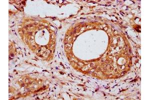 IHC image of ABIN7157079 diluted at 1:200 and staining in paraffin-embedded human cervical cancer performed on a Leica BondTM system. (IRX6 antibody  (AA 289-389))