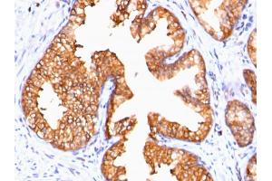 Formalin-fixed, paraffin-embedded human Prostate Carcinoma stained with ODC-1 Mouse Monoclonal Antibody (ODC1/485). (ODC1 antibody)