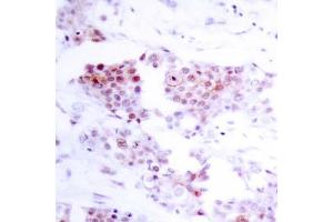 Immunohistochemical analysis of paraffin-embedded human breast carcinoma tissue using MEF2A (Ab-319) antibody (E021040). (MEF2A antibody)