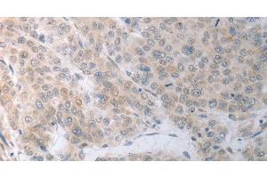 Immunohistochemistry of paraffin-embedded Human liver cancer using RBMS3 Polyclonal Antibody at dilution of 1:70 (RBMS3 antibody)