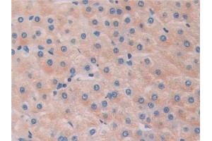 Detection of HDAC6 in Human Liver cancer Tissue using Polyclonal Antibody to Histone Deacetylase 6 (HDAC6) (HDAC6 antibody  (AA 166-348))