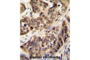 STK32A Antibody (N-term) immunohistochemistry analysis in formalin fixed and paraffin embedded human bladder carcinoma followed by peroxidase conjugation of the secondary antibody and DAB staining. (STK32A antibody  (N-Term))