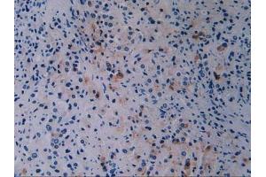 Detection of BRCA1 in Human Prostate Gland Cancer Tissue using Polyclonal Antibody to Breast Cancer Susceptibility Protein 1 (BRCA1) (BRCA1 antibody  (AA 19-83))