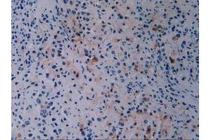 Detection of BRCA1 in Human Prostate Gland Cancer Tissue using Polyclonal Antibody to Breast Cancer Susceptibility Protein 1 (BRCA1)