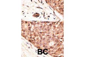 Formalin-fixed and paraffin-embedded human cancer tissue reacted with CDX2 polyclonal antibody  , which was peroxidase-conjugated to the secondary antibody, followed by AEC staining. (CDX2 antibody  (N-Term))