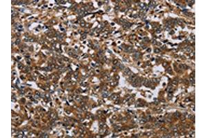 The image on the left is immunohistochemistry of paraffin-embedded Human liver cancer tissue using ABIN7191586(NCKAP1 Antibody) at dilution 1/30, on the right is treated with synthetic peptide. (NCKAP1 antibody)