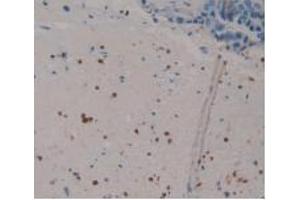 IHC-P analysis of Human Breast Cancer Tissue, with DAB staining. (S100P antibody  (AA 1-95))