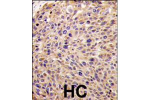 Formalin-fixed and paraffin-embedded human hepatocellular carcinoma reacted with GGPS1 polyclonal antibody  , which was peroxidase-conjugated to the secondary antibody, followed by DAB staining . (GGPS1 antibody  (N-Term))