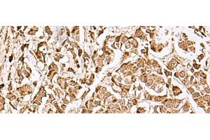 Immunohistochemistry of paraffin-embedded Human breast cancer tissue using MECR Polyclonal Antibody at dilution of 1:70(x200) (MECR antibody)