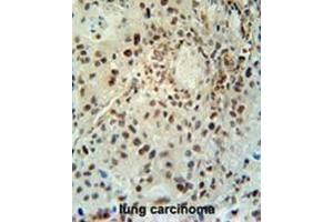 ABHEB Antibody (C-term) immunohistochemistry analysis in formalin fixed and paraffin embedded human lung carcinoma followed by peroxidase conjugation of the secondary antibody and DAB staining. (ABHD14B antibody  (C-Term))