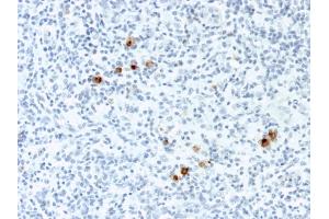 Formalin-fixed, paraffin-embedded human Hodgkin's Lymphoma stained with EBV Mouse Monoclonal Antibody (CS-4).