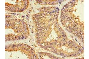 Immunohistochemistry of paraffin-embedded human endometrial cancer using ABIN7176145 at dilution of 1:100 (ZNF2 antibody  (AA 134-289))