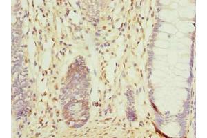 Immunohistochemistry of paraffin-embedded human colon cancer using ABIN7148064 at dilution of 1:100 (CCDC16 antibody  (AA 1-280))
