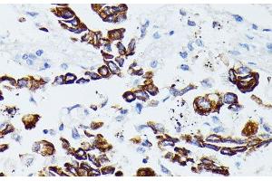 Immunohistochemistry of paraffin-embedded Human lung cancer using MMP25 Polyclonal Antibody at dilution of 1:100 (40x lens). (MMP25 antibody)