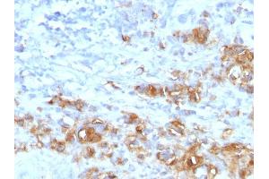 Formalin-fixed, paraffin-embedded human Gastric Carcinoma stained with CA19-9 Rabbit Recombinant Monoclonal Antibody (CA19.