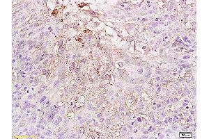 Formalin-fixed and paraffin embedded human cervical carcinoma labeled Anti-HIF-1-Alpha Polyclonal Antibody (ABIN672546), Unconjugated at 1:300, followed by conjugation to the secondary antibody and DAB staining (HIF1A antibody  (AA 341-450))