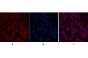 Immunofluorescence analysis of human liver cancer tissue. (Histone H2B antibody)