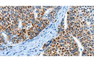Immunohistochemistry of paraffin-embedded Human liver cancer using ALDH4A1 Polyclonal Antibody at dilution of 1:45 (ALDH4A1 antibody)