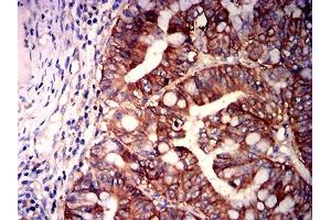 Immunohistochemical analysis of paraffin-embedded rectum cancer tissues using CD147 mouse mAb with DAB staining. (CD147 antibody  (AA 138-323))