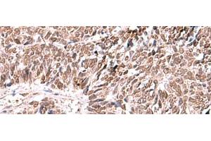 Immunohistochemistry of paraffin-embedded Human lung cancer tissue using FDPS Polyclonal Antibody at dilution of 1:60(x200)