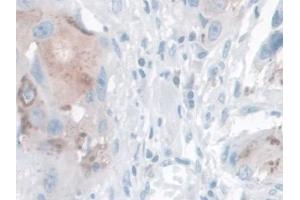 Detection of KLK14 in Human Breast cancer Tissue using Polyclonal Antibody to Kallikrein 14 (KLK14) (Kallikrein 14 antibody  (AA 36-267))