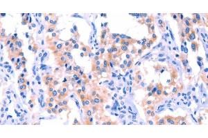 Immunohistochemistry of paraffin-embedded Human thyroid cancer tissue using ERN2 Polyclonal Antibody at dilution 1:40 (ERN2 antibody)