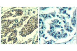 Immunohistochemical analysis of paraffin-embedded human breast carcinoma tissue using Cyclin B1(Phospho-Ser147) Antibody(left) or the same antibody preincubated with blocking peptide(right). (Cyclin B1 antibody  (pSer147))