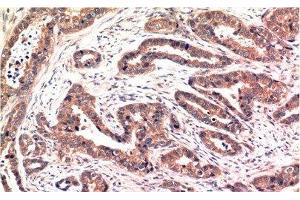 Immunohistochemistry of paraffin-embedded Human breast carcinoma tissue using Phospho-AKT1 (Ser473) Monoclonal Antibody at dilution of 1:200 (AKT1 antibody  (pSer473))