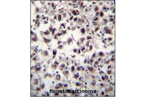 Immunohistochemistry analysis in Formalin Fixed, Paraffin Embedded Human Hepatocarcinoma tissue stained with SFRS7 Antibody (N-term) followed by peroxidase conjugation of the secondary antibody and DAB staining. (SFRS7 antibody  (N-Term))
