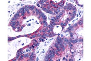 Anti-O3FAR1 / GPR120 antibody IHC of human Colon, Carcinoma. (O3FAR1 antibody  (C-Term))