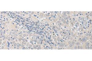 Immunohistochemistry of paraffin-embedded Human cervical cancer tissue using LYRM2 Polyclonal Antibody at dilution of 1:50(x200) (LYRM2 antibody)