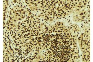 ABIN6276991 at 1/100 staining Human breast cancer tissue by IHC-P. (PSMB5 antibody  (C-Term))