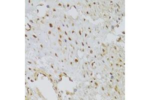 Immunohistochemistry of paraffin-embedded human leiomyoma of uterus using HNRNPA1 Antibody (ABIN5975570) at dilution of 1/100 (40x lens). (HNRNPA1 antibody)