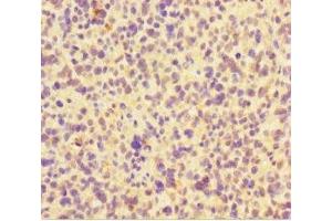 Immunohistochemistry of paraffin-embedded human glioma using ABIN7165362 at dilution of 1:100