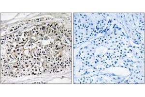Immunohistochemistry analysis of paraffin-embedded human breast carcinoma tissue, using EHHADH Antibody. (EHHADH antibody  (AA 476-525))
