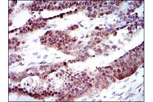 Immunohistochemical analysis of paraffin-embedded ovarian cancer tissues using CYP1A1 mouse mAb with DAB staining. (CYP1A1 antibody)