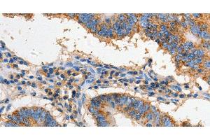 Immunohistochemistry of paraffin-embedded Human colon cancer using FAS Polyclonal Antibody at dilution of 1:60 (FAS antibody)
