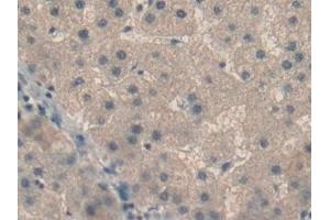 Detection of RBP5 in Human Liver cancer Tissue using Polyclonal Antibody to Retinol Binding Protein 5, Cellular (RBP5)
