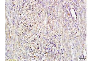 Formalin-fixed and paraffin embedded human cervical carcinoma labeled with Mouse Anti-AFP(A4) Monoclonal Antibody, Unconjugated (bsm-1622M) at 1:200 followed by conjugation to the secondary antibody and DAB staining. (alpha Fetoprotein antibody)