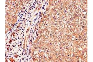Immunohistochemistry of paraffin-embedded human liver cancer using ABIN7150398 at dilution of 1:100 (IGHMBP2 antibody  (AA 646-884))