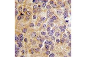 IHC analysis of FFPE human prostate carcinoma tissue stained with PRMT3 antibody (PRMT3 antibody  (AA 142-173))