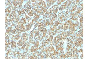 Immunohistochemistry (IHC) image for anti-Epithelial Cell Adhesion Molecule (EPCAM) (AA 20-60), (N-Term) antibody (ABIN6939994)